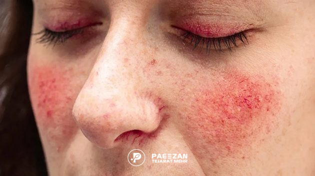 پروفایلو برای انواع پوست