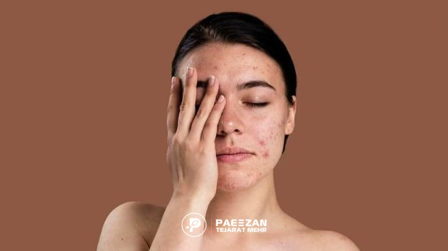 تاثیر پروفایلو بر جای جوش