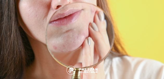 تأثیر پروفایلو بر منافذ باز پوست 1
