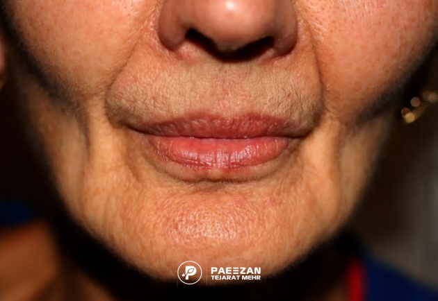 افتادگی پوست صورت بعد از لاغری