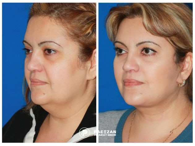 افتادگی پوست صورت بعد از لاغری