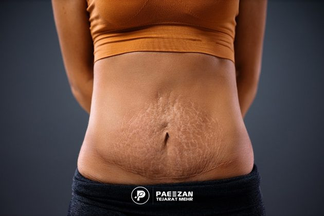 Understanding the Post Pregnancy Belly