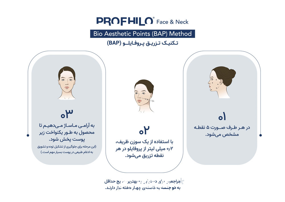 تکنیک تزریق پروفایلو