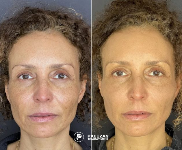 استراکچورا برای جوانسازی
