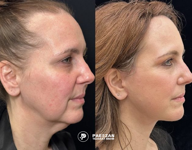افتادگی پوست صورت بعد از لاغری