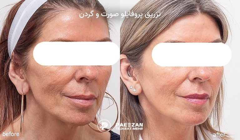 پروفایلو before afteredit