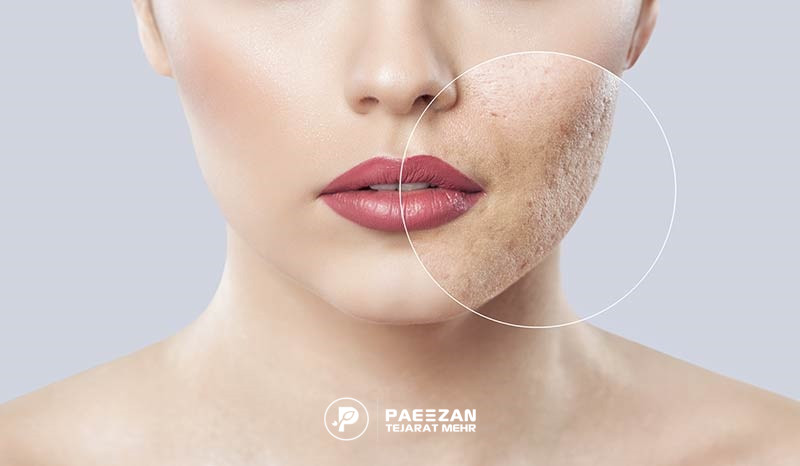 لیزر جوانسازی صورت