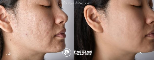 عکس قبل و بعد رفع جای جوش و اسکار آکنه با پروفایلو
