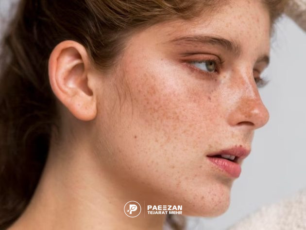 عکس نیم رخ دختری که صورت او کک و مک دارد