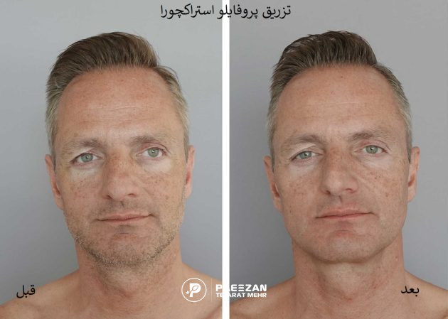پروفایلو استراکچورا برای مردان 2 عکس قبل و بعد صورت مردی که پروفایلو استراکچورا تزریق کرده است و پوست او شفاف تر و جوان تر شده است
