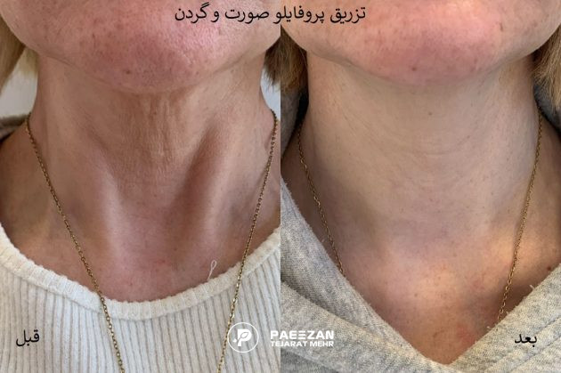عکس قبل و بعد تزریق پروفایلو به گردن زن که باعث رفع شلی و افتادگی پوست شده است و روی عکس نوشته شده تزریق پروفایلو صورت و گردن