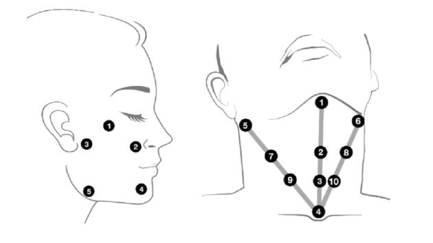 نواحی تزریق پروفایلو روی صورت و گردن با اعداد مشخص شده است