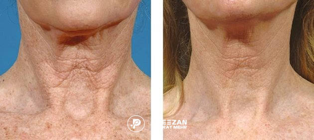 جوانسازی گردن