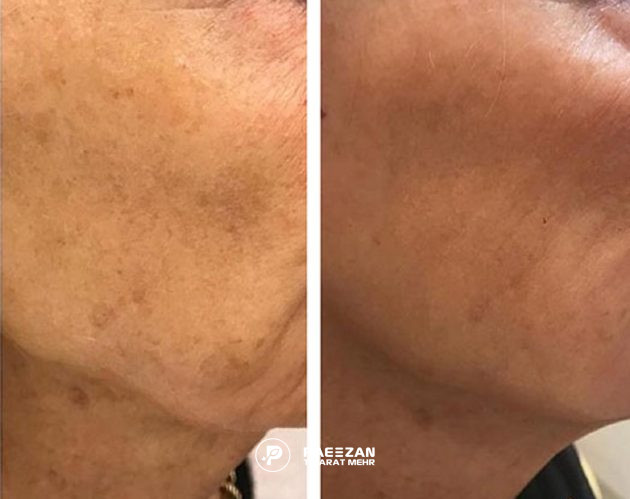 عکس قبل و بعد لیفت صورت بدون جراحی با تزریق پروفایلو استراکچورا
