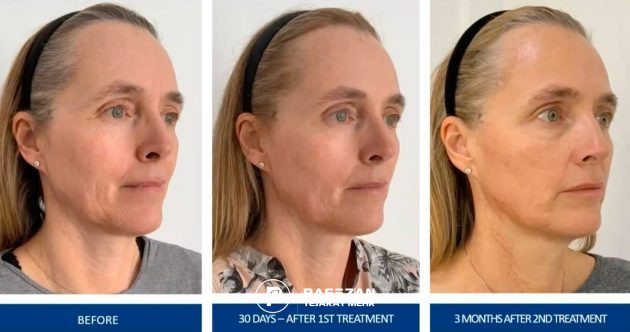 عکس قبل از تزریق استراکچورا و ۳۰ روز بعد و ۳ ماه بعد از تزریق