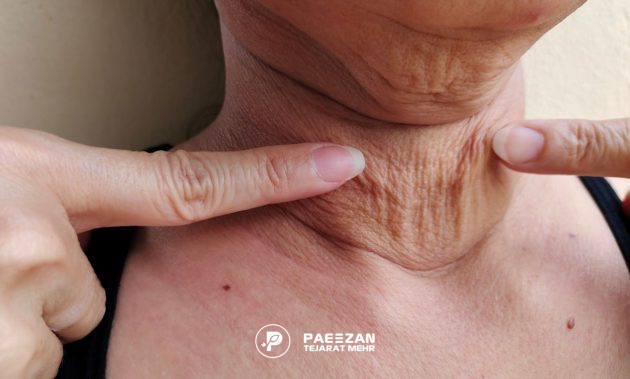  شل شدن پوست در لاغری