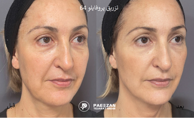  شل شدن پوست در لاغری