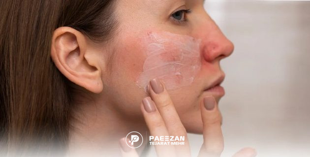 دختری که صورت او قرمز شده و روی نواحی ملتهب کرم می زند