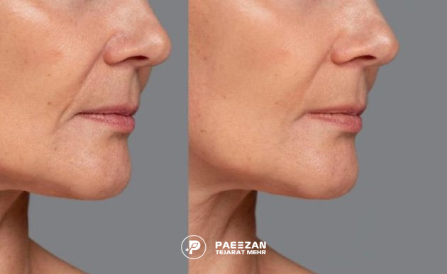 عکس قبل و بعد از نتایج پروفایلو