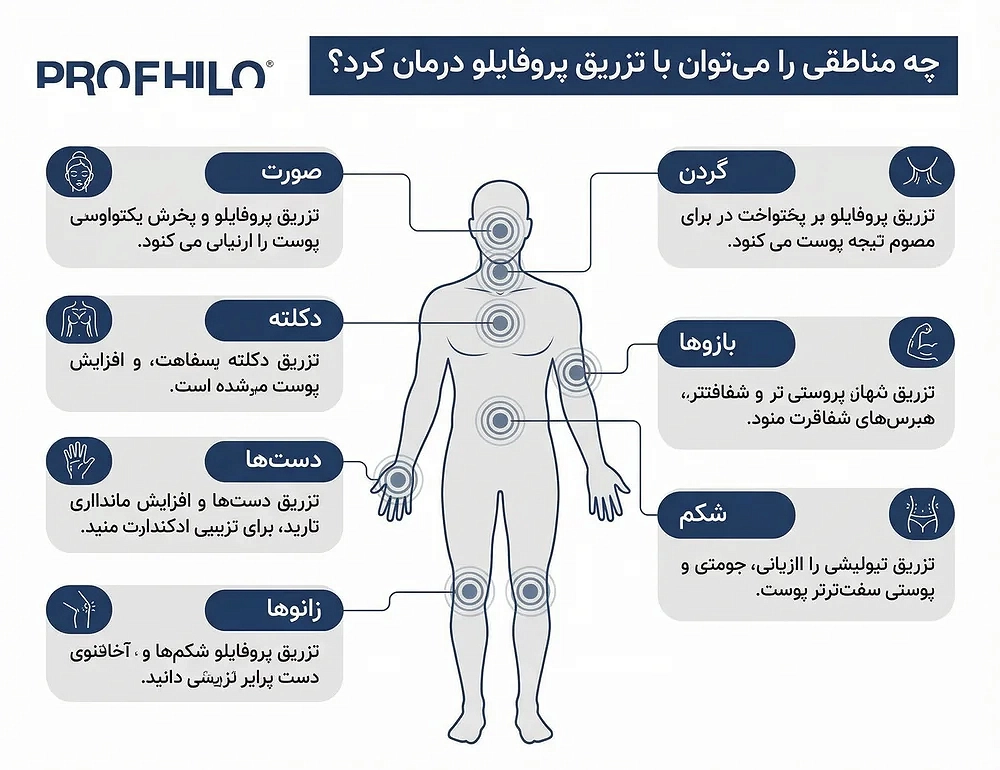 پروفایلو (Profhilo) چیست و چه مزایایی دارد؟ معرفی، مزایا و نحوه تزریق 49 چه مناطقی را می توان با تزریق پروفایلو درمان کرد؟