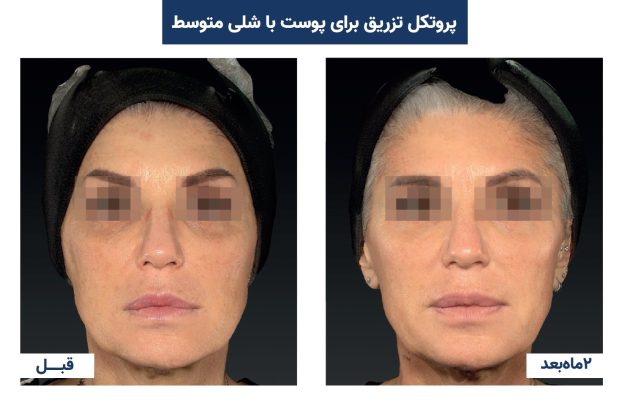 معرفی رویکرد جوانسازی چند لایه پوست (Multi- Layer Rejuvenation Approach) 2 رویکرد جوانسازی چند لایه پوست
