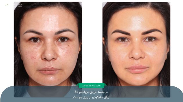 جلوگیری از پیری پوست