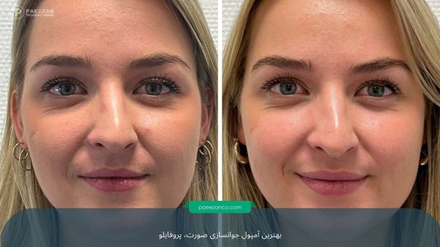 آمپول جوانسازی صورت