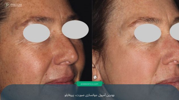 آمپول جوانسازی صورت