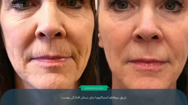 درمان افتادگی پوست بدون جراحی