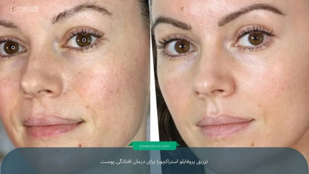 درمان افتادگی پوست بدون جراحی