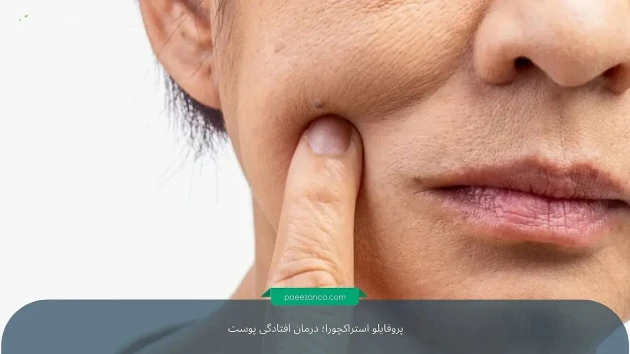 درمان افتادگی پوست بدون جراحی