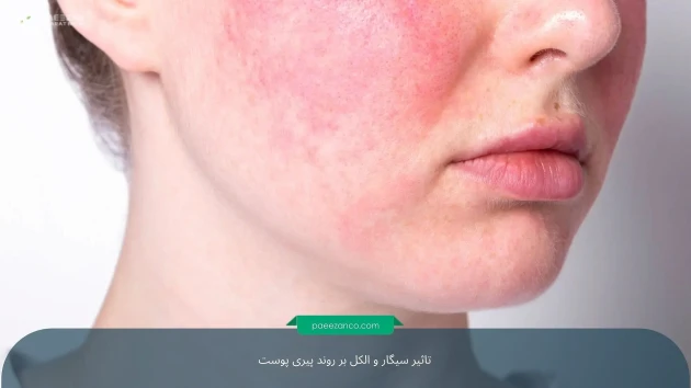 تاثیر سیگار و الکل بر روند پیری پوست 2 تاثیر سیگار و الکل بر روند پیری پوست