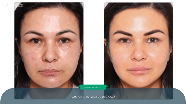 راهنمای درمان خشکی پوست صورت 3 خشکی پوست صورت