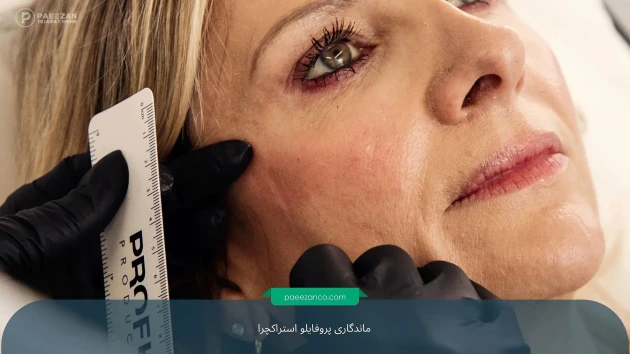 ماندگاری پروفایلو استراکچرا چقدر است؟ 1 ماندگاری پروفایلو استراکچرا