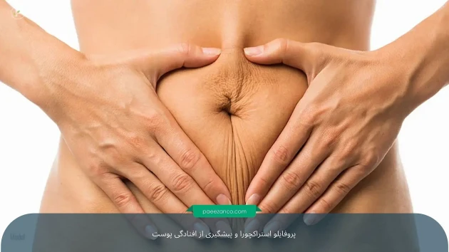 پروفایلو استراکچورا و پیشگیری از افتادگی پوست