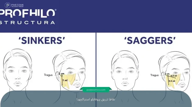 آشنایی با نقاط تزریق پروفایلو استراکچورا 2 نقاط تزریق پروفایلو استراکچورا