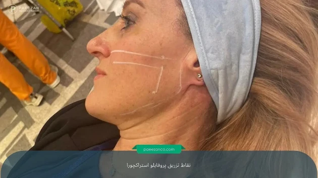 آشنایی با نقاط تزریق پروفایلو استراکچورا 3 نقاط تزریق پروفایلو استراکچورا
