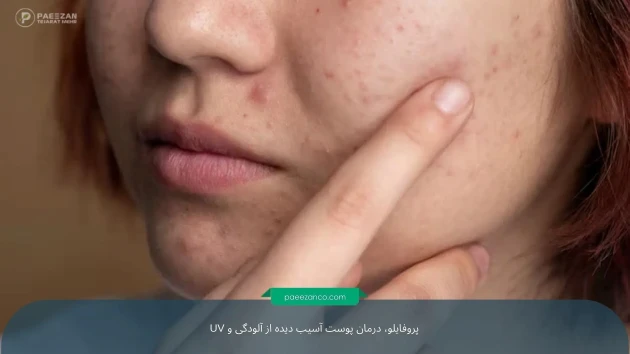 درمان پوست خسته و آسیب دیده از آلودگی و UV 2 درمان پوست خسته و آسیب دیده از آلودگی و UV