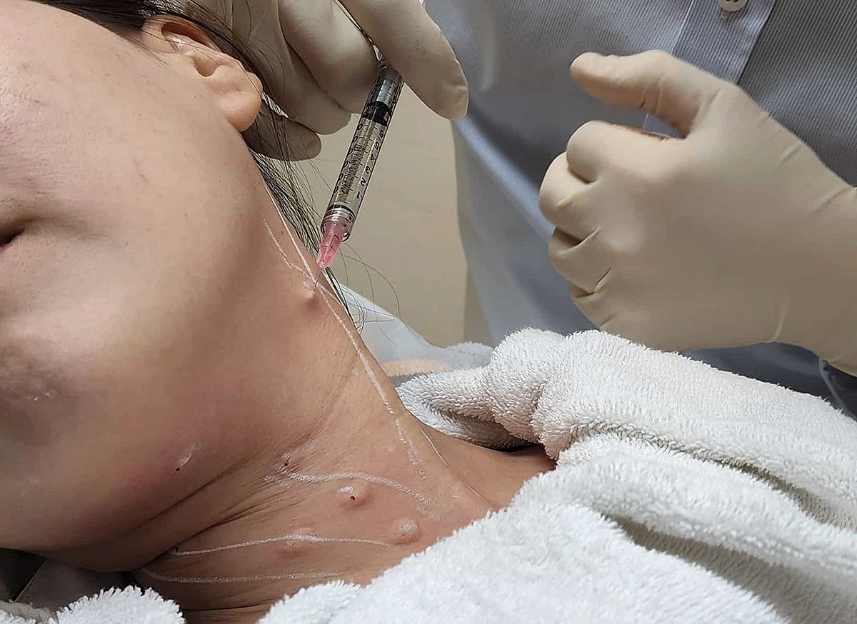 بهترین دکتر تزریق پروفایلو در شیراز چه کسی است؟ 1 مراجعه کننده زن که صورت خود را به سمت راست متمایل کرده و پزشکی که درحال تزریق پروفایلو 64 به نقاطی از گردن او است