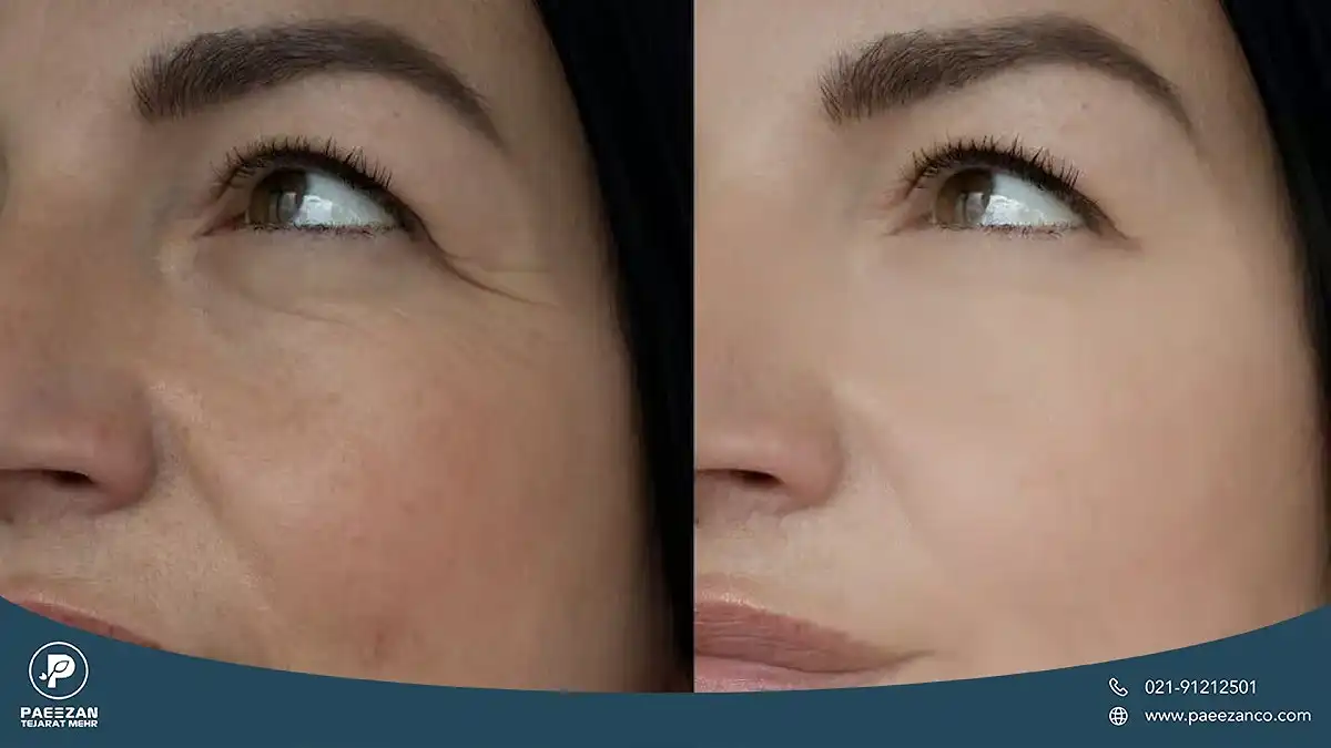 عکس از قبل و بعد جوانسازی صورت دختری با سلول های بنیادی