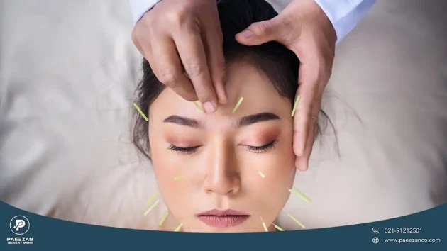 دختری که چشم های خود را بسته و فردی روی پوست صورت او طب سوزنی انجام می دهد
