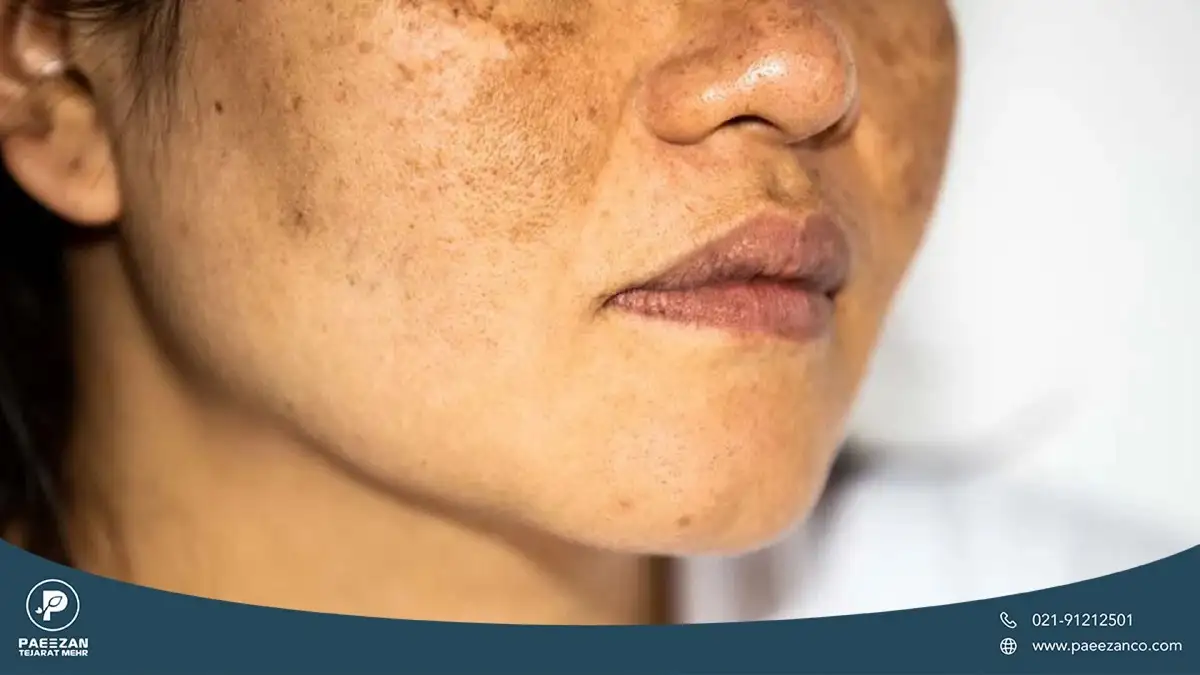 نیمه ی پایین صورت دختری که پوست او دچار تیرگی و لک پوستی شده است