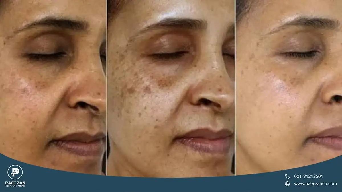 سه عکس در کنار هم از مراحل رفع تیرگی پوست صورت زن