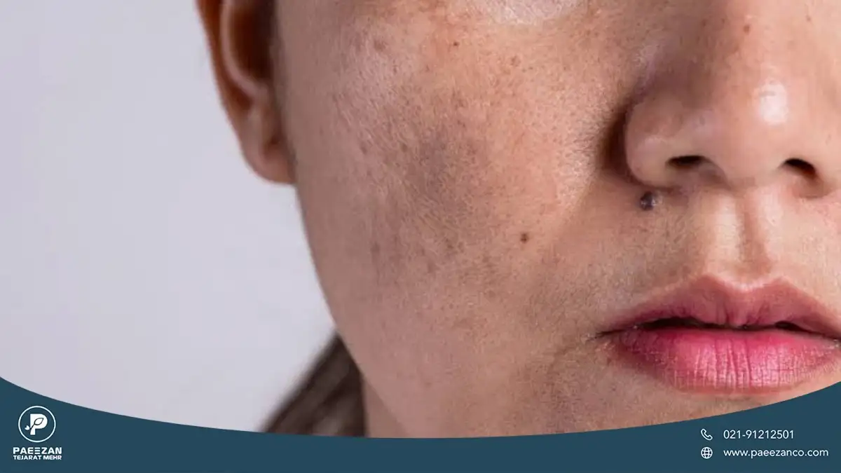دختری که پوست سمت راست او کمی تیره شده است