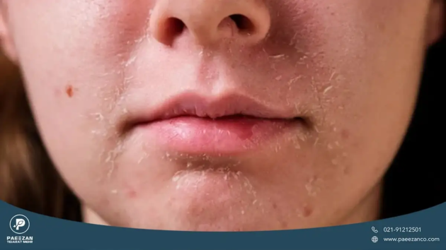 دختری که پوست صورت او دچار خشکی است و اطراف دهان او پوسته پوسته شده است