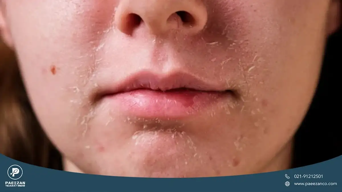 دختری که پوست صورت او دچار خشکی است و اطراف دهان او پوسته پوسته شده است
