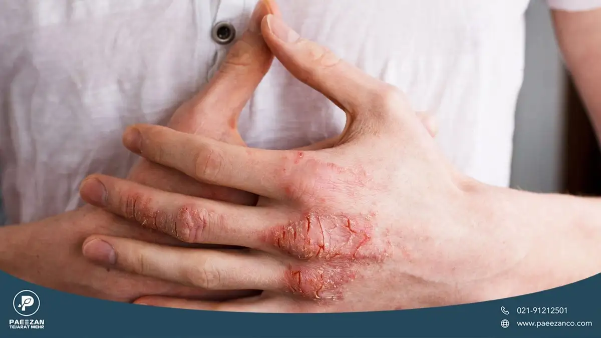 عکس از دست های فردی که ناحیه مفاصل دست او دچار خشکی و التهاب و قرمزی شده است