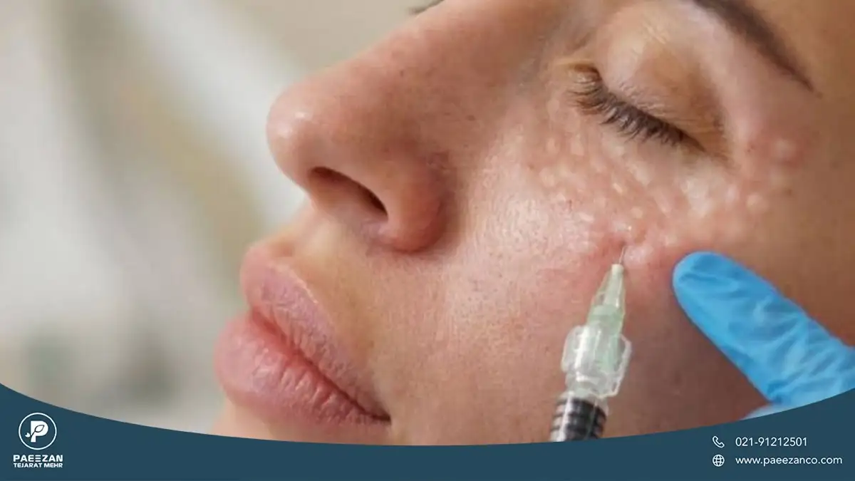صورت دختری که پزشک به گونه او مزوژل تزریق کرده است