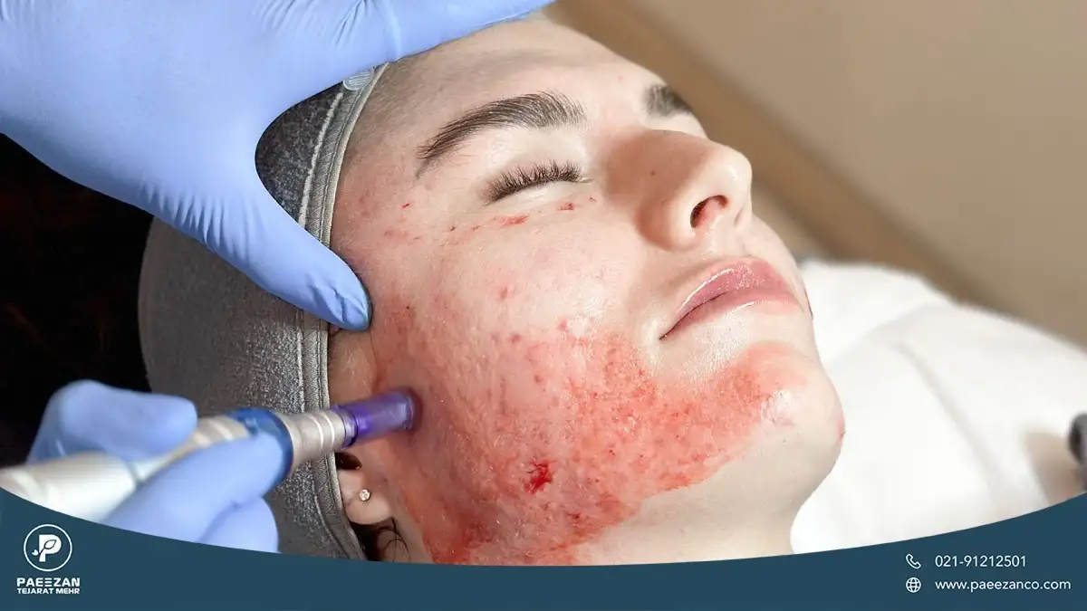 دختری که پزشک صورت او را میکرونیدلینگ می کند و پوست او قرمز و ملتهب شده است