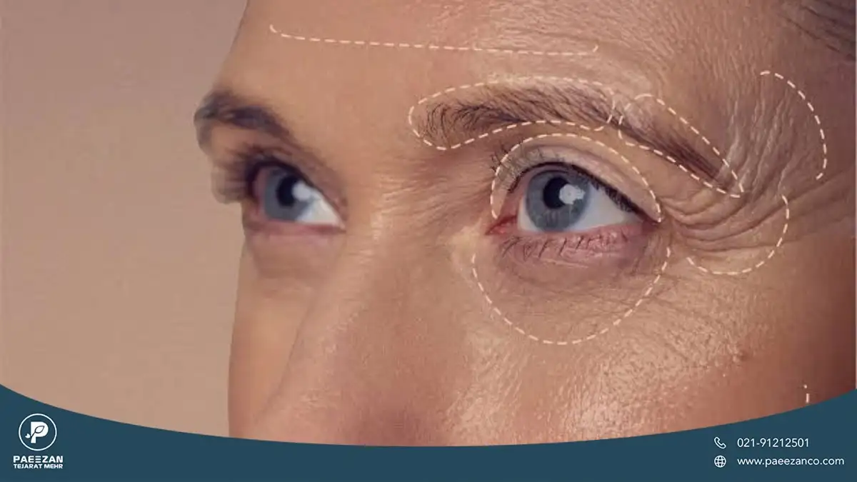عکس از چشم یک زن که چین و چروک ها و خطوط اطراف چشم با خط چین سفید مشخص شده است